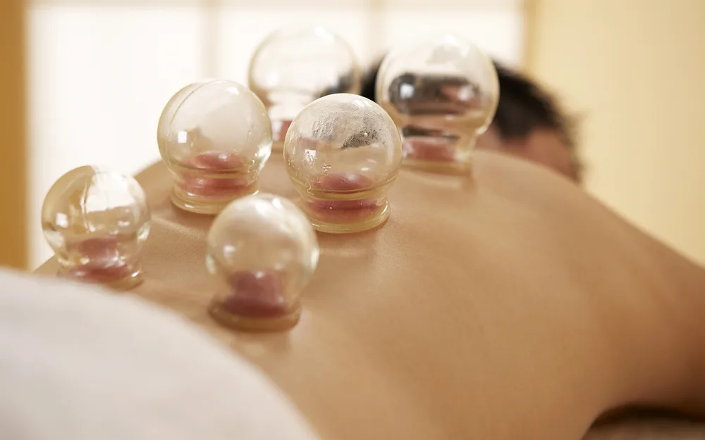 Cupping (Hijama) Therapy